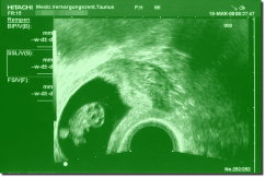 Ultrasound Scan Art Print 15 x 10 cm - Forest green