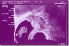 Ultrasound Scan Art Print 15 x 10 cm - Purple